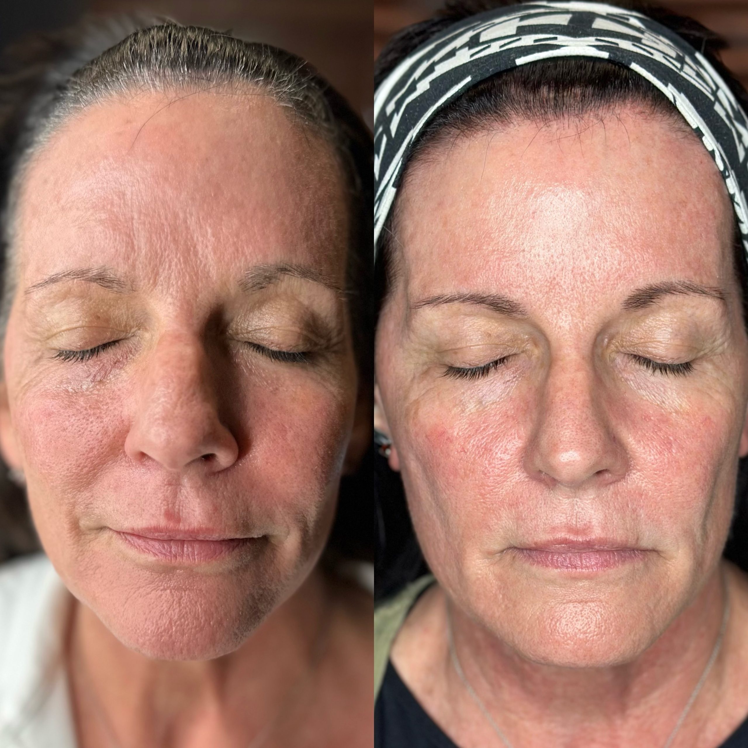 Morpheus8 patient, Tracy Atwood before and after