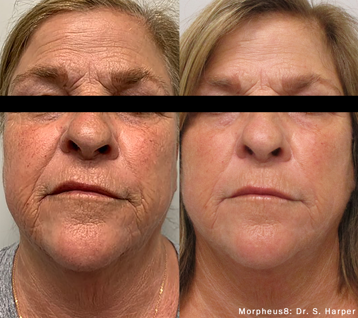 Morpheus8 face before and after age management